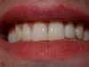 bicarbonate de soude pour les dents